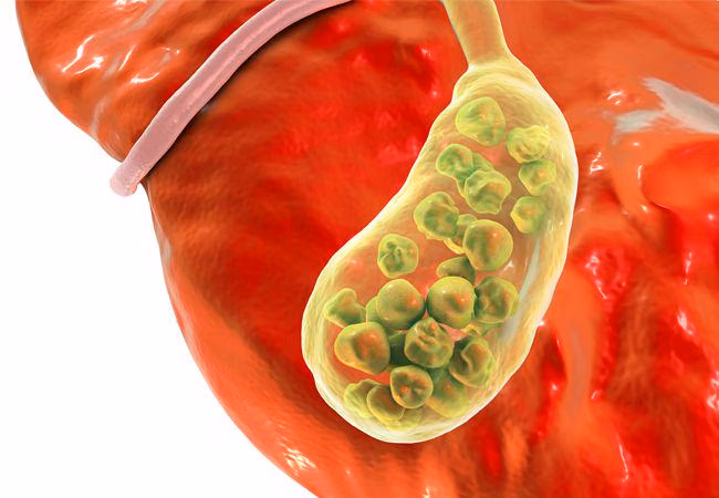 penyebab batu empedu